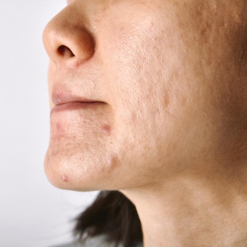 Acne scar treatment in Heswall, Wirral, Merseyside at Sarah White Laser and Aesthetics Clinic