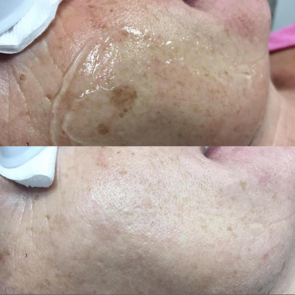 M22 IPL for Pigmentation at Sarah White Laser and Aesthetics in Heswall, Wirral, Merseyside
