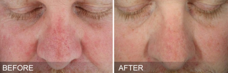 Sun damage results from Hydrafacial in Heswall, Wirral, near Liverpool