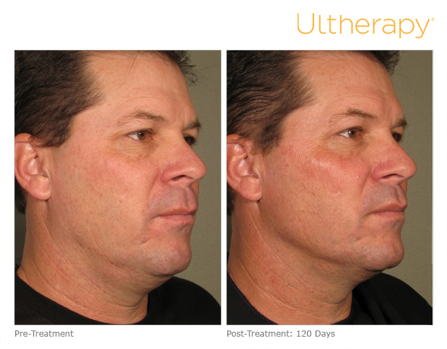 Ultherapy before and after Sarah White Aesthetics Heswall Wirral
