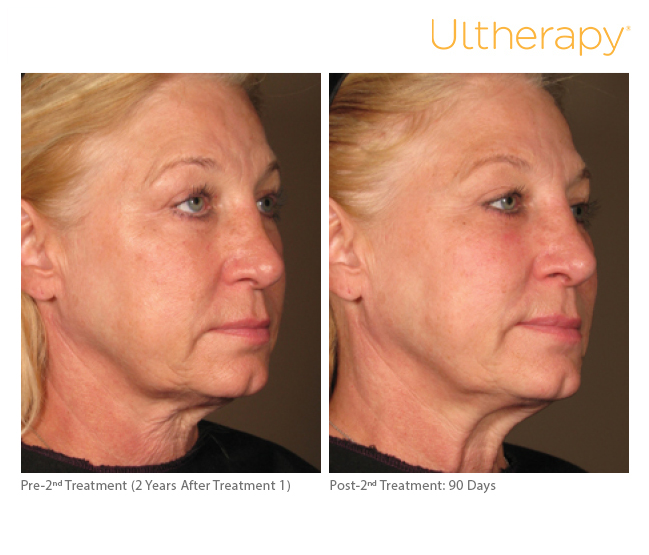 Ultherapy before and after Sarah White Aesthetics Heswall Wirral